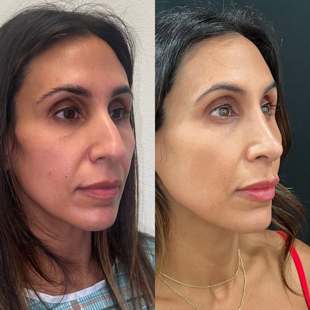 Rhinoplasty Case #91226-1