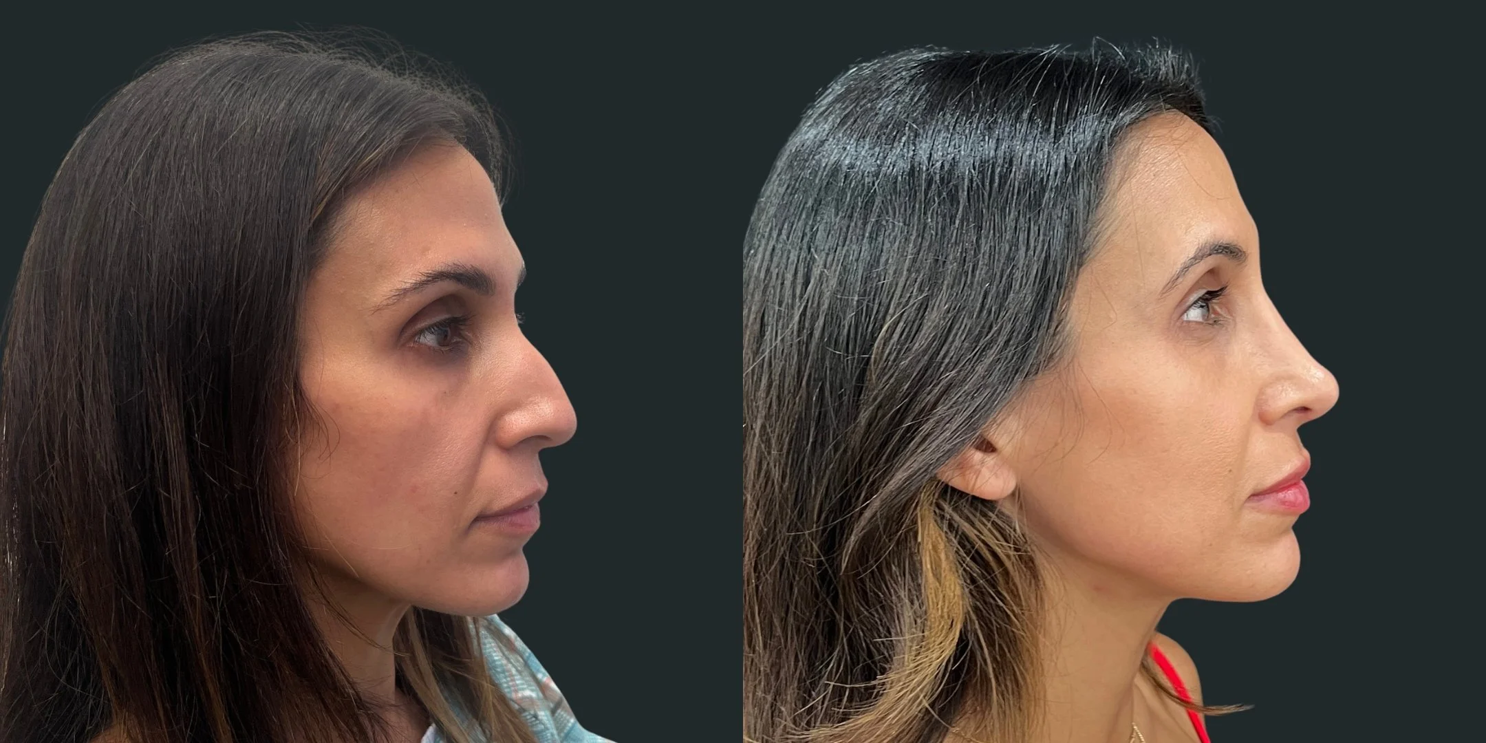 dr-michael-omidi-before-and-after-photo-of-client-rhinoplasty (5).jpg