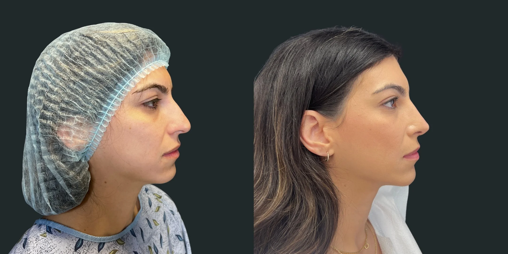 dr-michael-omidi-before-and-after-photo-of-client-rhinoplasty (3).jpg