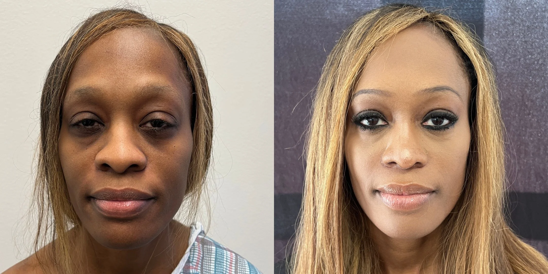 dr-michael-omidi-before-and-after-photo-of-client (3).jpg