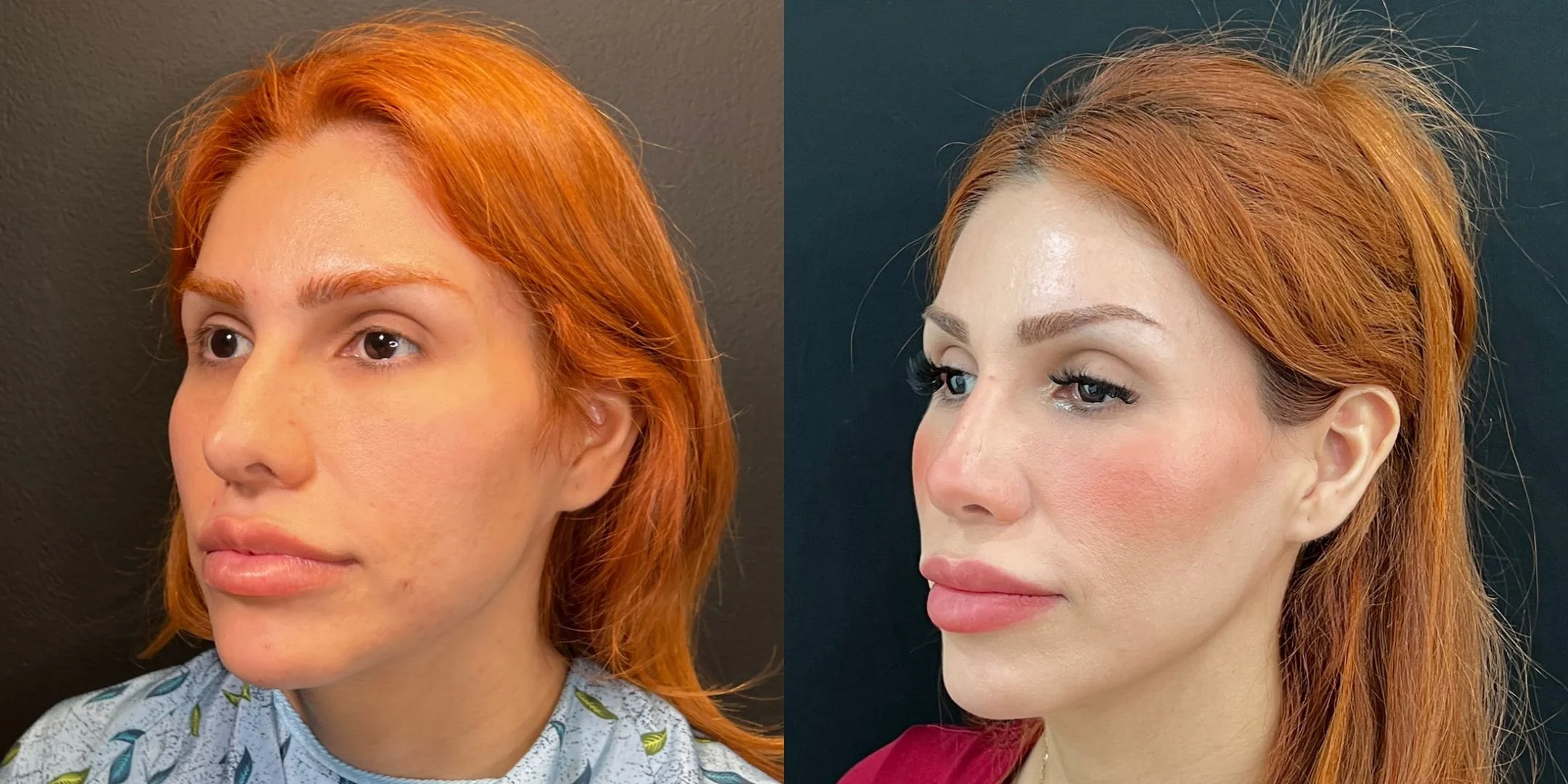 dr-michael-omidi-before-and-after-photo-of-client-revision-rhinoplasty (2).jpg