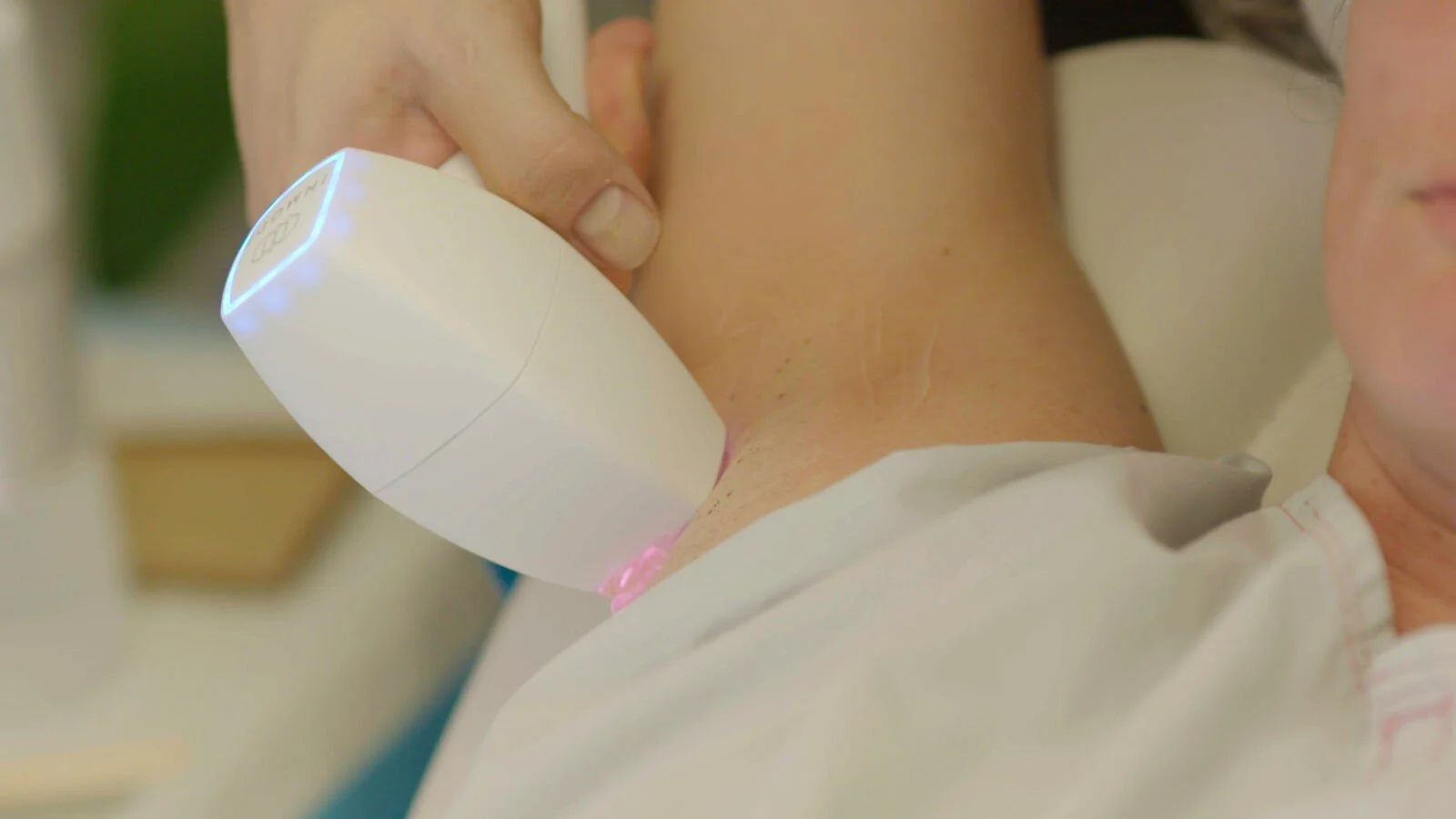 A person receiving a medical or cosmetic procedure on their armpit using a handheld device with a blue light.