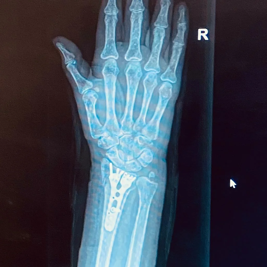 Update on the broken arm - I got cleared to start rehab today (not the Amy Winehouse kind) it&rsquo;s going to be a long journey, (two fractures and dislocation) but if you know me, you know I&rsquo;m determined to draw again. 
Thank you for all  you