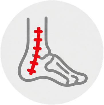 Ankle surgery recovery