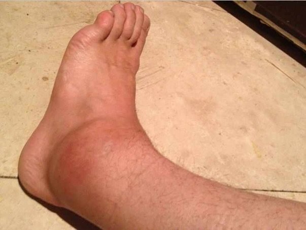 If your ankle looks like this after the weekend… you’re going to want this 👉
Our CryoPush system combines cold therapy + active compression to:
✅ Reduce swelling and inflammation
✅ Speed up healing after sprains
✅ Help manage pain
✅ G