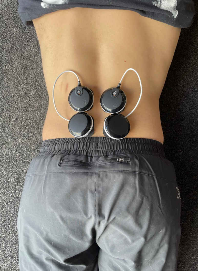 Compex EMS muscle stimulator electrode placement during knee surgery rehabilitation — quad activation and atrophy prevention