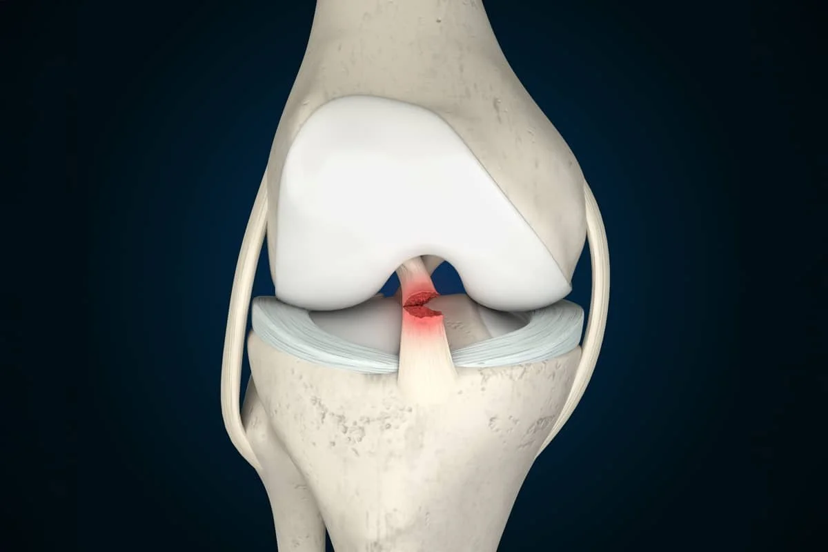 Illustration of a human knee joint with a highlighted area indicating inflammation or injury.