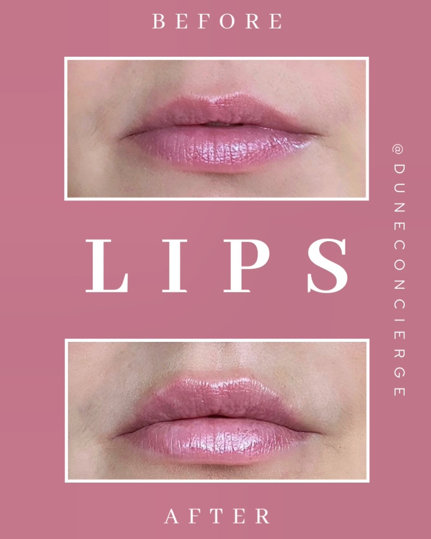 Embracing the power of subtle enhancements✨💋

Lip filler before and after, using Juv&eacute;derm Ultra Plus XC for a natural enhancement. @sophiagr 

For Appointments:
📲Text: (347) 271-0816