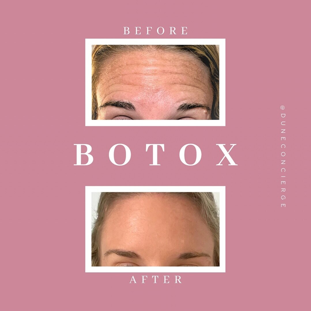 ✨ 💉Botox treatment to the forehead and glabellar complex (the 11&rsquo;s).

⏰Images are 4 weeks apart: Typically, you will start to see results within 7-14 days.

🌈 Botox treatments will soften expression lines but also prevent them from deepening.