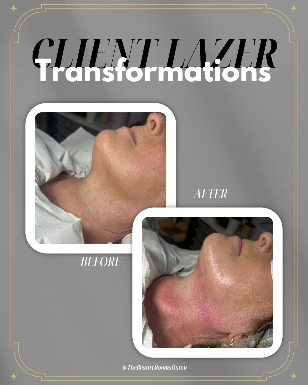 ✨Radiance Contour Facial✨
Neck + Jaw Sculpting Treatment

Skin rejuvenating lasers are one of the most effective ways to restore smoother, firmer, healthier-looking skin 🌿

This treatment can help improve:
&bull; Fine lines + crepey texture
&bull; S