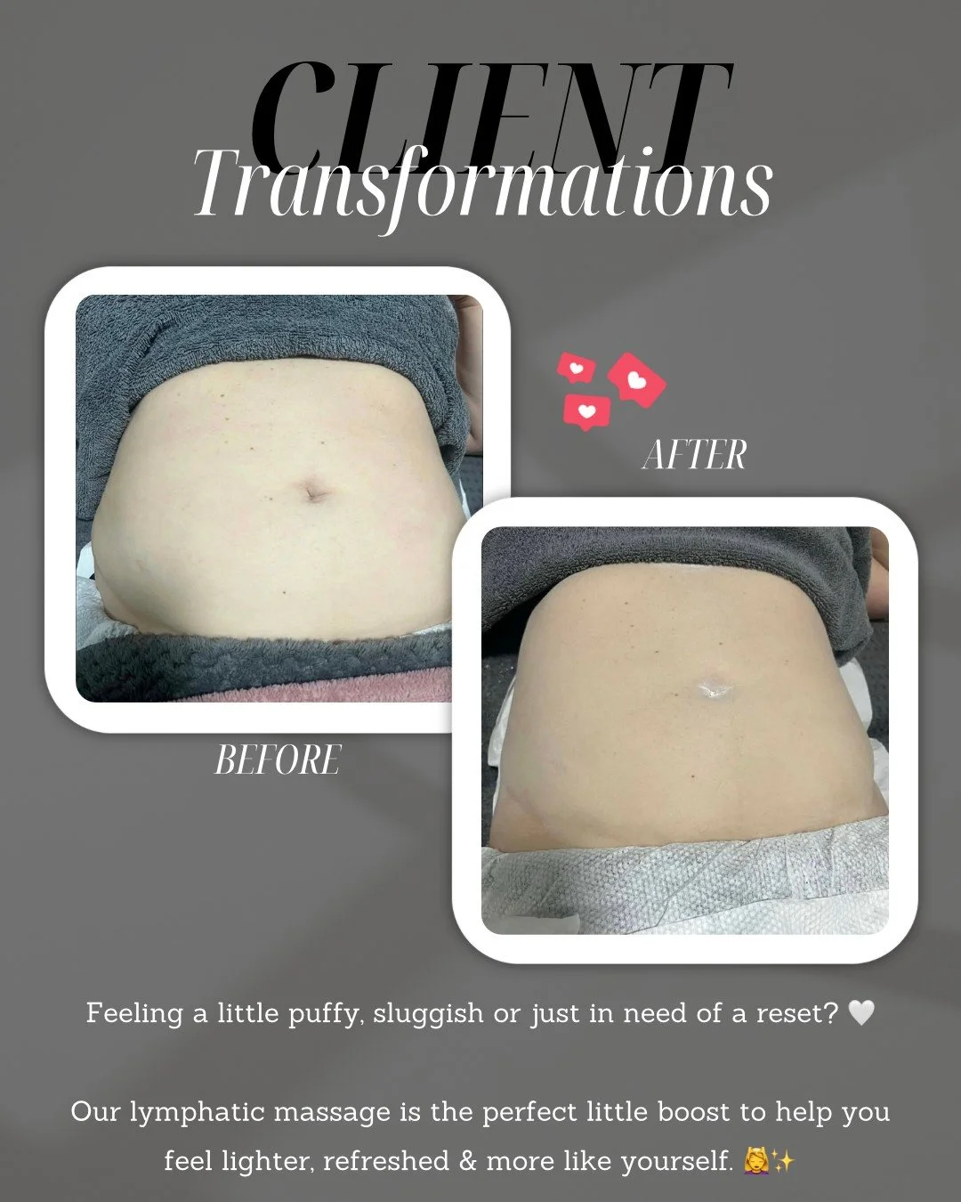 ✨ BEFORE &amp; AFTER ✨

One lymphatic drainage massage, one little reset. 🤍

If you&rsquo;re feeling puffy, bloated or like your body needs a boost, lymphatic drainage massage can help encourage fluid movement and leave you feeling lighter, refreshe