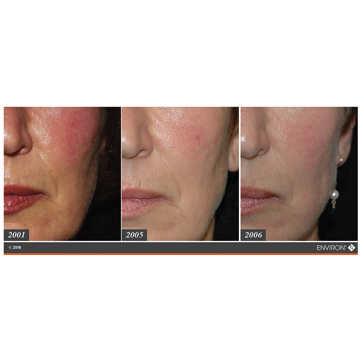 🎉 I love looking over Dr Des's records of his before and after photographs👏
🎉 You can clearly see the improvements in these pics of one of his patients over a period of 5 years using Environ Skin EssentiA Moisturiser morning and night.
🎉 Environ 
