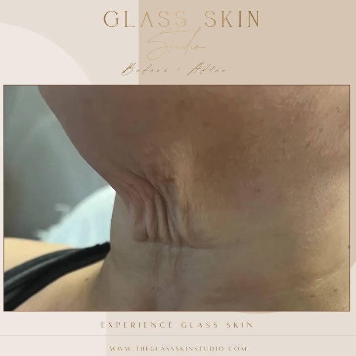 JET PLASMA ✨ 

NO downtime. NO pain. Jet Plasma is a non-invasive treatment that uses 14,000 volts of plasma energy to restructure the collagen from the inside out. What does this mean for you? 

🤍 refined fine lines and wrinkles
🤍 a lifted and ton