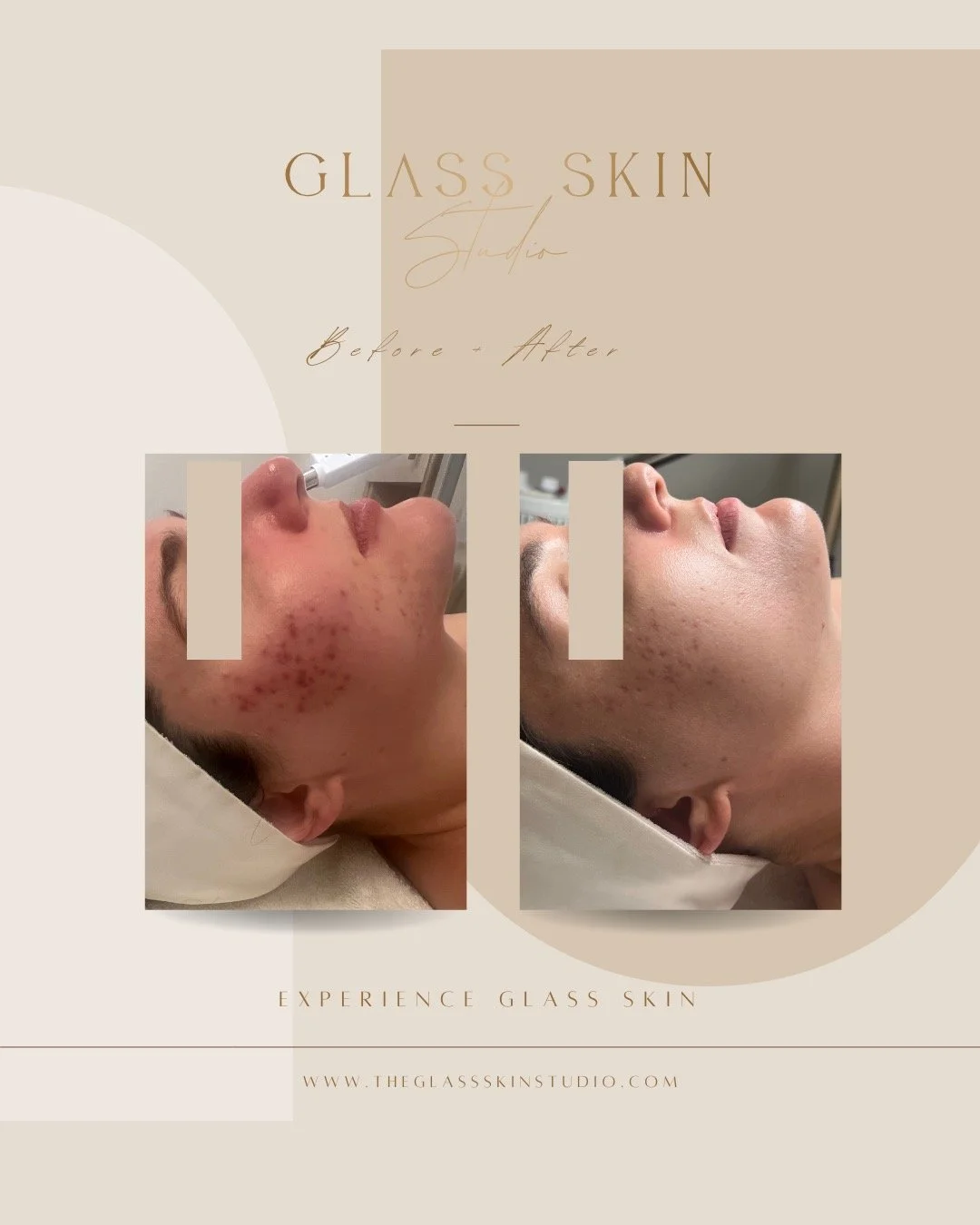 Our favorite thing: Helping clients love their skin.

The treatment: 3 sessions of Microchanneling + BioRePeel &amp; 3 sessions of Jet Plasma

MICROCHANNELING
Activate your body&rsquo;s natural healing process to:

🤍 Stimulate collagen
🤍 Smooth tex