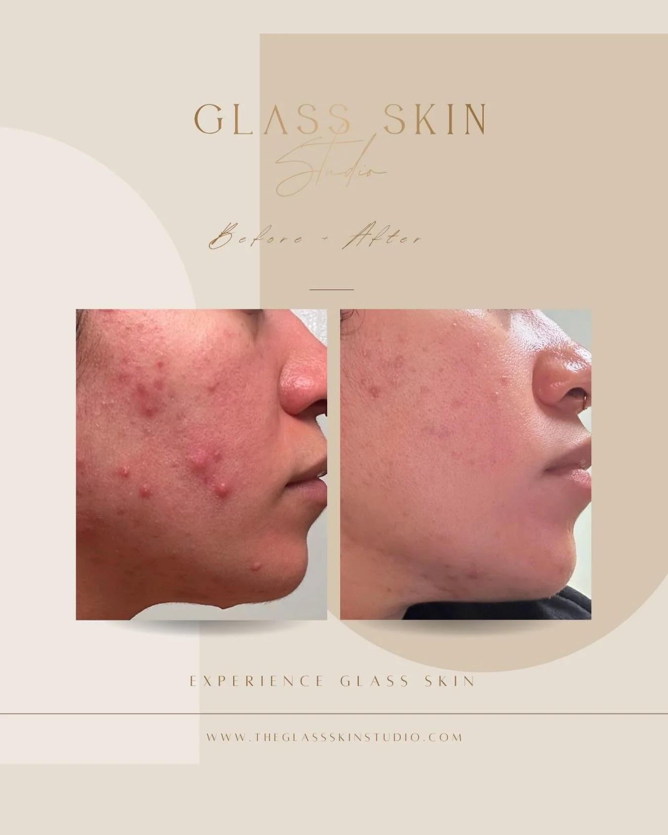 Looking for clearer, smoother, and brighter skin, but don&rsquo;t know where to start? Here&rsquo;s our treatment for this client&rsquo;s stubborn acne:

☁️ Glass Skin Get Clear Facials: Designed to clear skin congestion, hydrate, and soothe inflamma