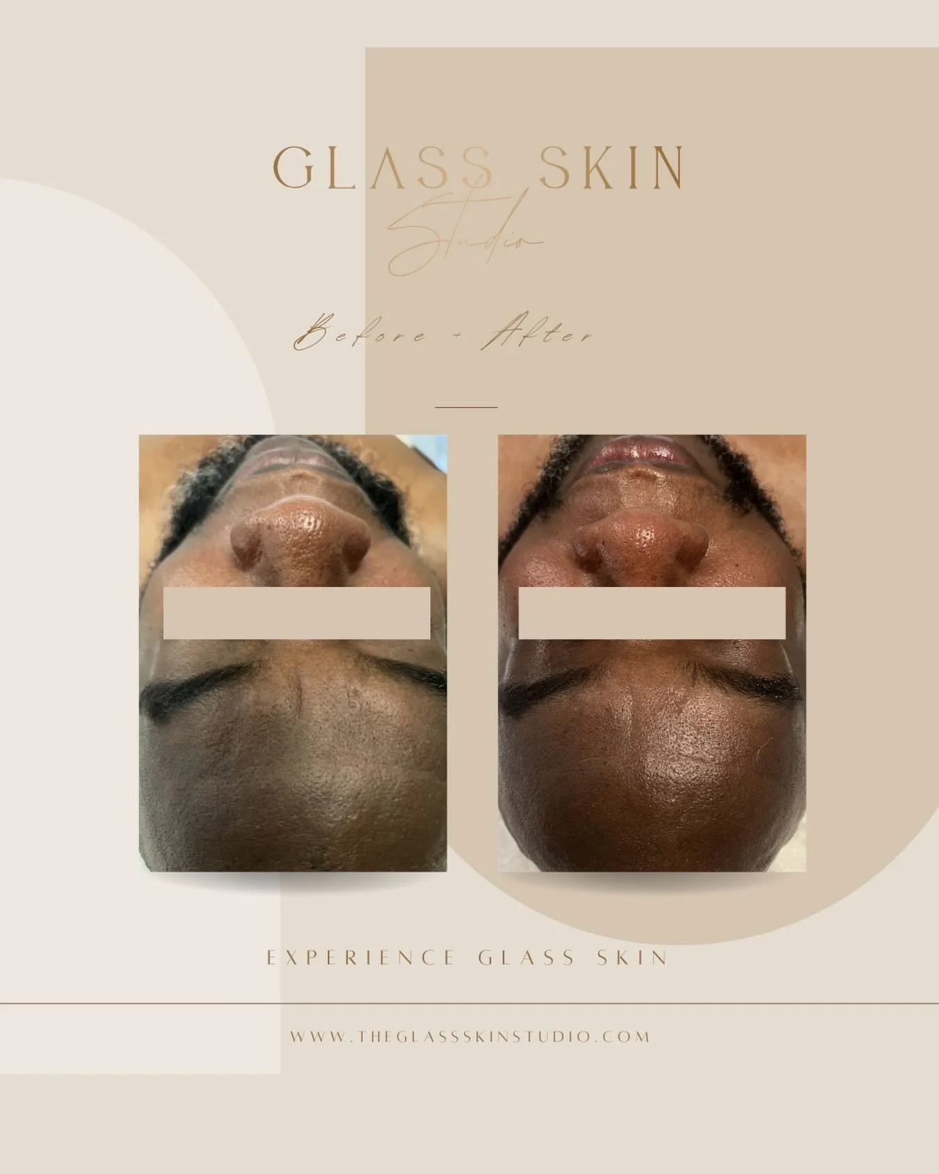 Look at that glow 🌟

At Glass Skin Studio, we believe that consistency is the key to results. Here&rsquo;s how we helped our client achieve brighter, smoother, and rejuvenated skin:

✨ JET PLASMA

Collagen-boosting technology with zero downtime. Thi