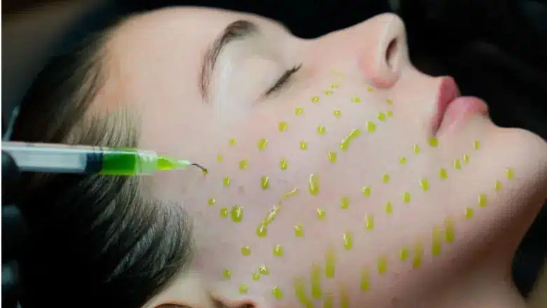 chemical peel biorepeel