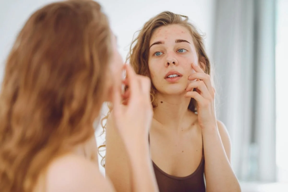 Overly aggressive acne treatments can damage the skin barrier