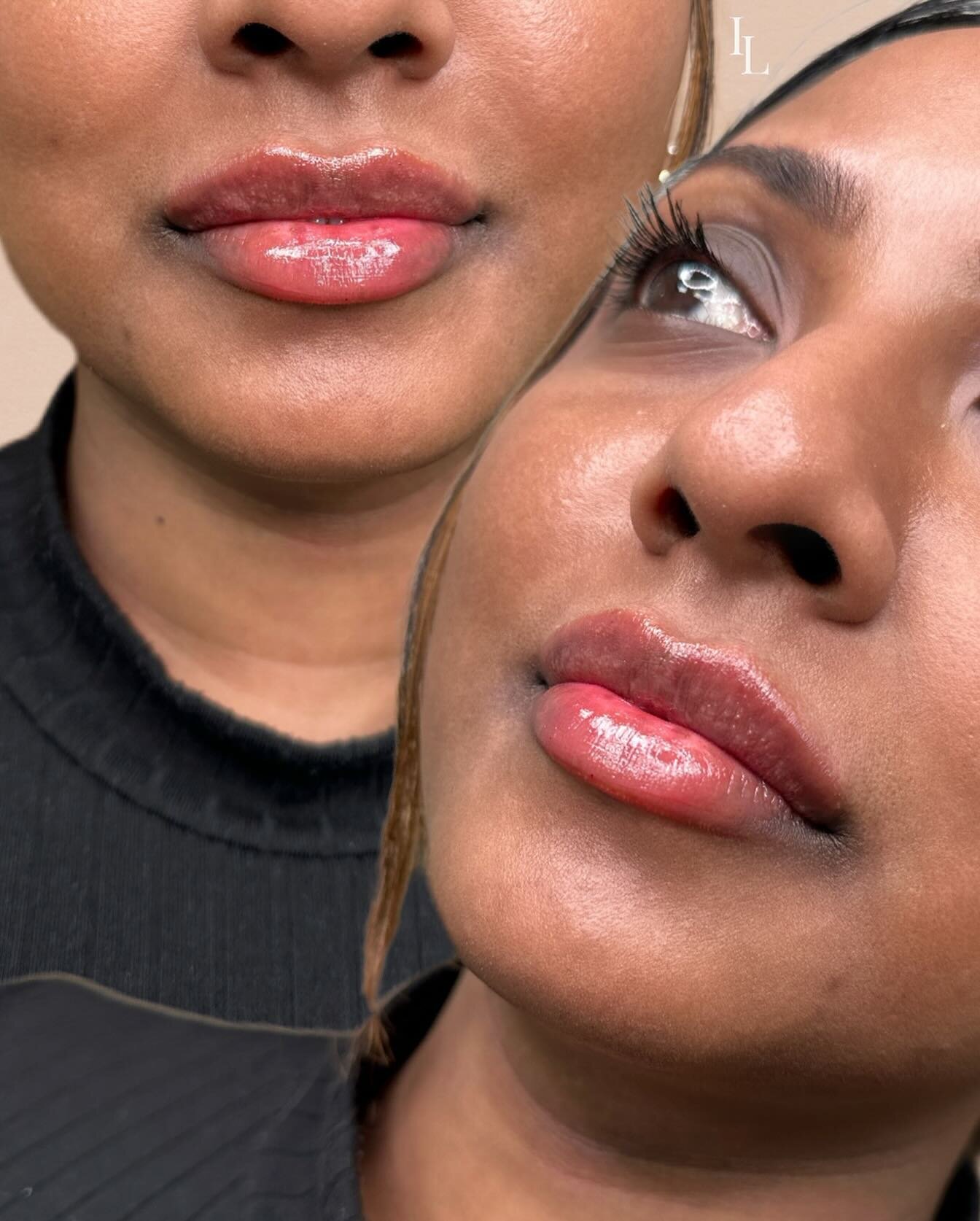 𝐋𝐢𝐩 𝐫𝐞𝐟𝐫𝐞𝐬𝐡 🫦 

Client request: Mini lip pout treatment = natural plump with definition ✔️

Location 📍 621 Sheppard Ave East North York ON 
📲 647-668-3802
💌 info@theinjectionlounge.com

Where to get filler Toronto, filler Toronto, top r