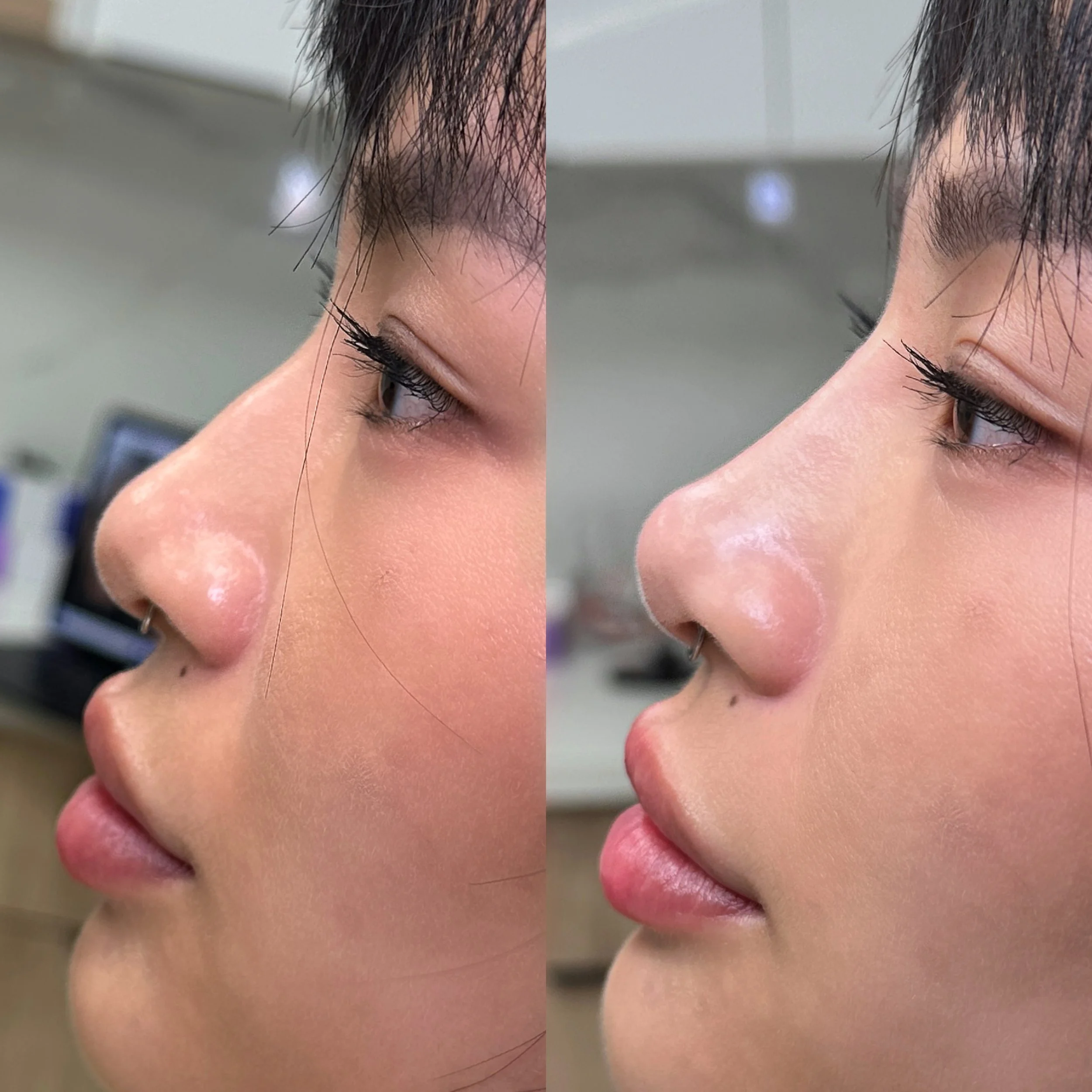 NON SURGICAL RHINOPLASTY

&rarr;Immediate results
&rarr;No downtime 
&rarr;No surgery required 

🏠 @injectionlounge 👩🏻&zwj;⚕️ @nursejessw 
📲 647-668-3802
📍 621 Sheppard Ave E North York ON
💌 info@theinjectionlounge.com
🖥️ www.theinjectionloung