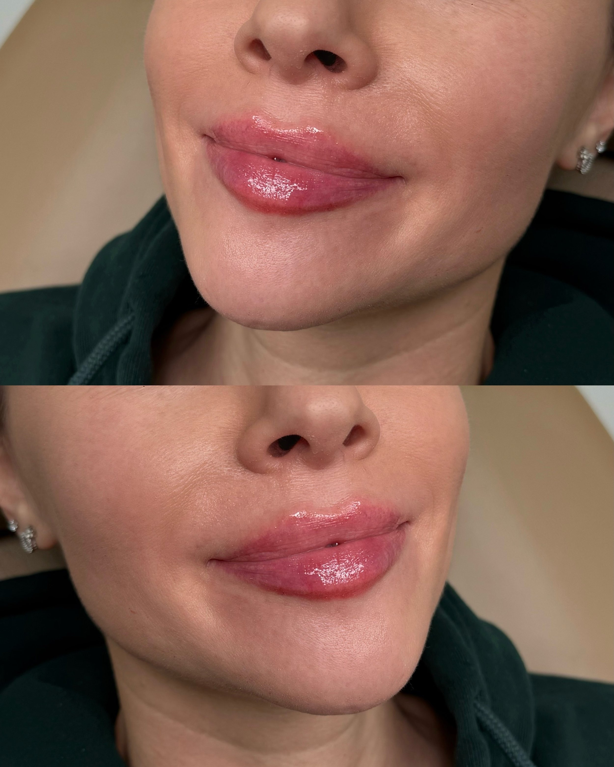 A soft, natural-looking lip filler result 🌷

Location 📍 621 Sheppard Ave East North York | Toronto
📲 647-668-3802
💌 info@theinjectionlounge.com
👩🏻&zwj;⚕️ By Nurse Tala @cosmeticnursetala