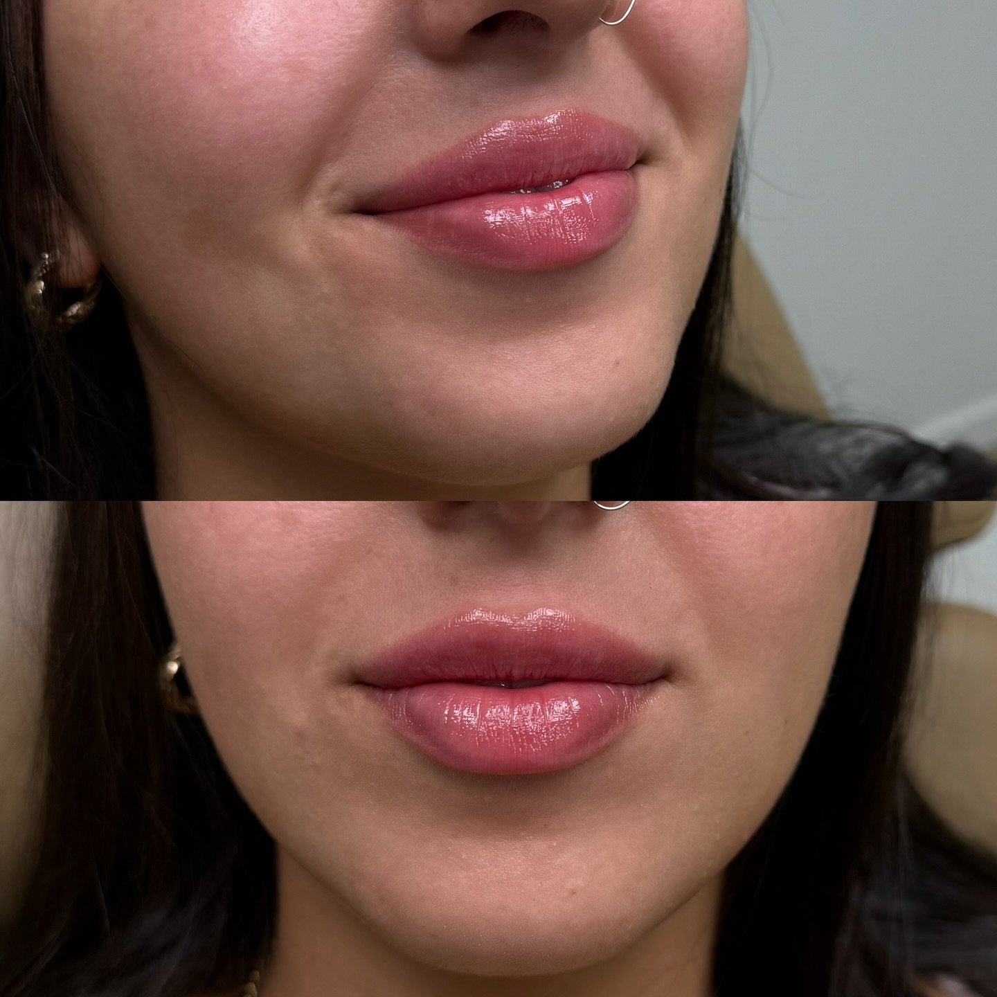 Natural-looking, undetectable fillers ✨💖💉 What Injection Lounge is known for : Creating beautiful, natural-looking results that work with your features 🤍

Location 📍 621 Sheppard Ave E. North York, ON
📲 647-668-3802
🖥️ info@theinjectionlounge.c