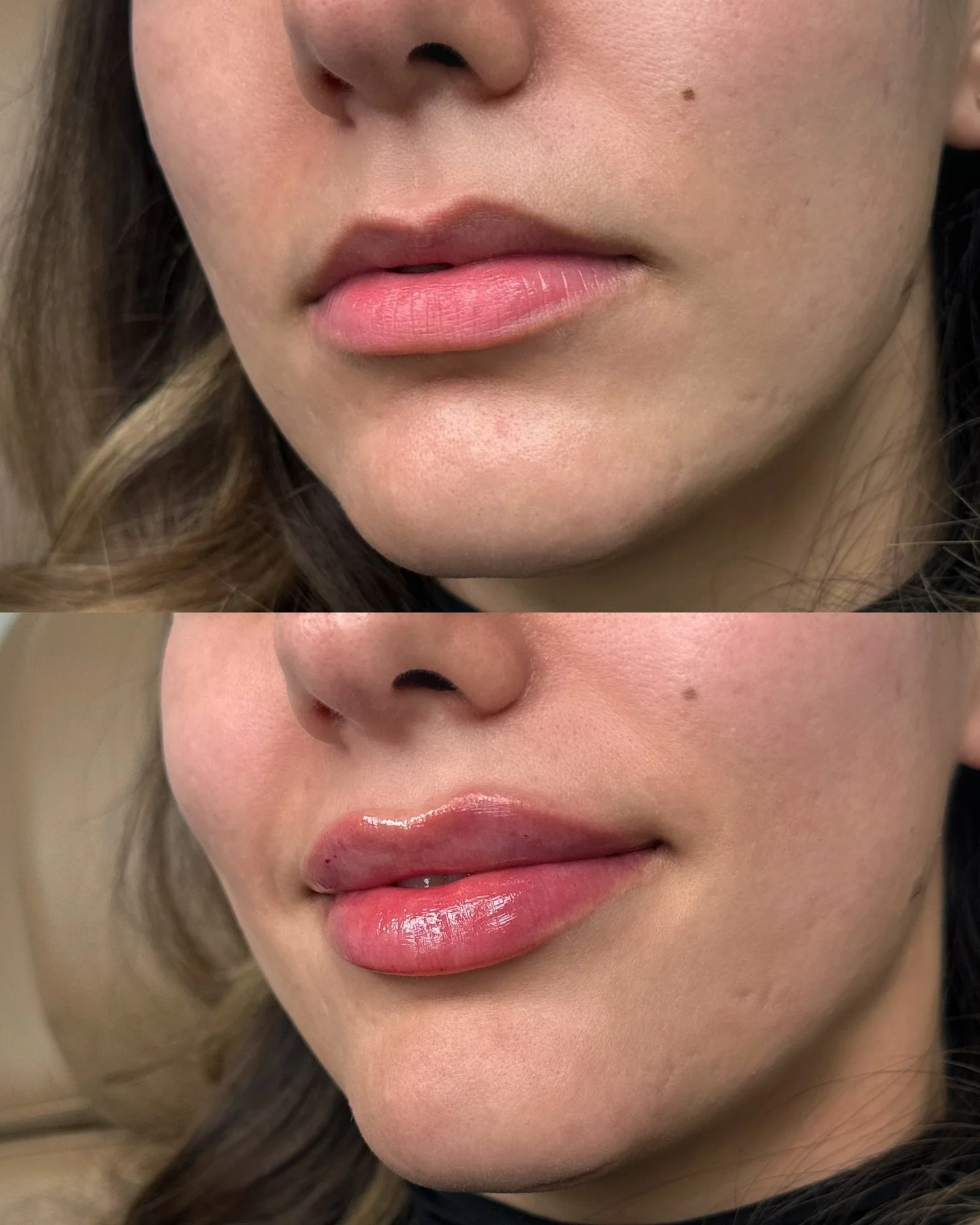 Lip filler transformation 🦋 Dermal filler was used to re-shape these lips to perfection 👄

Treatment: Full Syringe Lip Pout 

Location 📍621 Sheppard Ave E. North York, Ontario
📞 647-668-3802
💌 info@theinjectionlounge.com
💬 Text/Call/DM for any 
