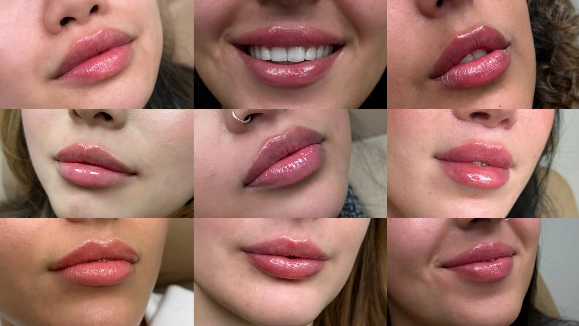 The best place for natural looking lip filler results