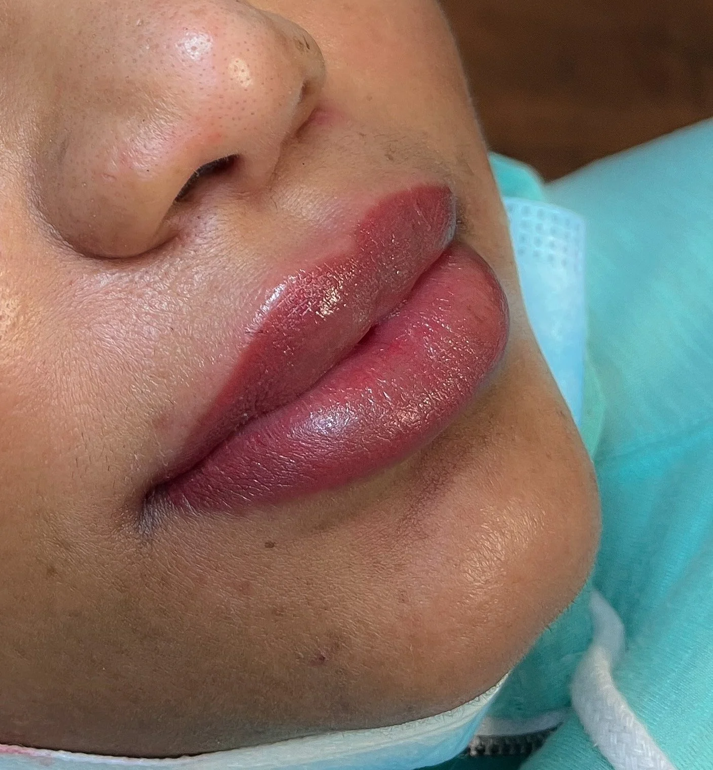 Close-up of a person's lips and nose, showing the person lying down wearing a medical mask pulled down below the nose, with a turquoise-colored shirt or gown.