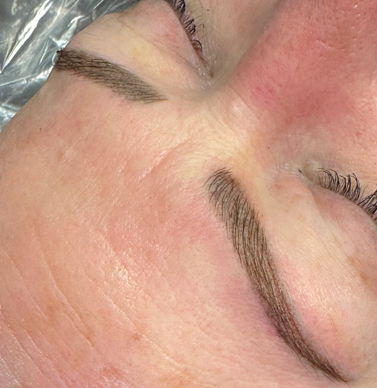Close-up of a person's forehead, eyebrows, and closed eyes. The individual appears to have recently received a cosmetic eyebrow procedure.