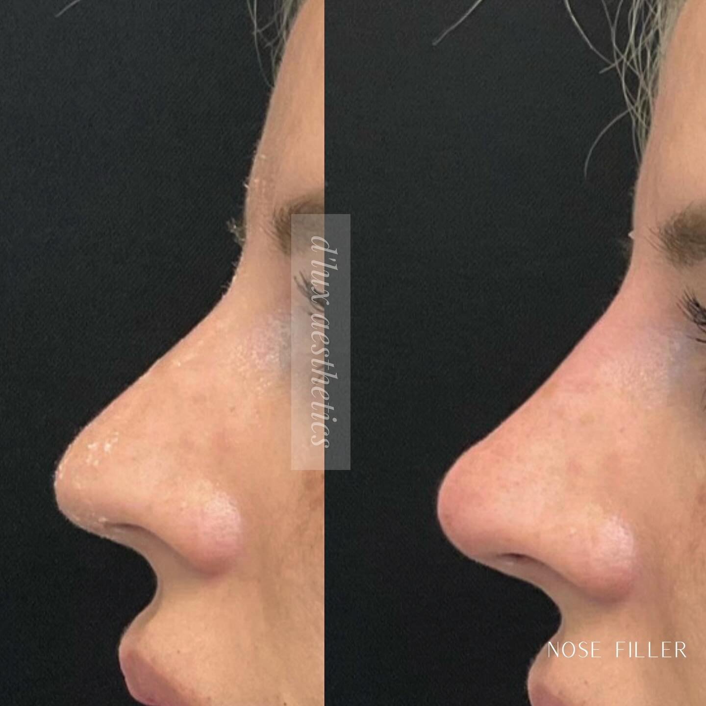 What are Nose Fillers? 👃🏼👇🏼

Nose fillers are injectable substances used to enhance specific areas of the nose. They&rsquo;re typically made of hyaluronic acid (HA), a naturally occurring sugar molecule that adds volume and hydration.

Remember: 