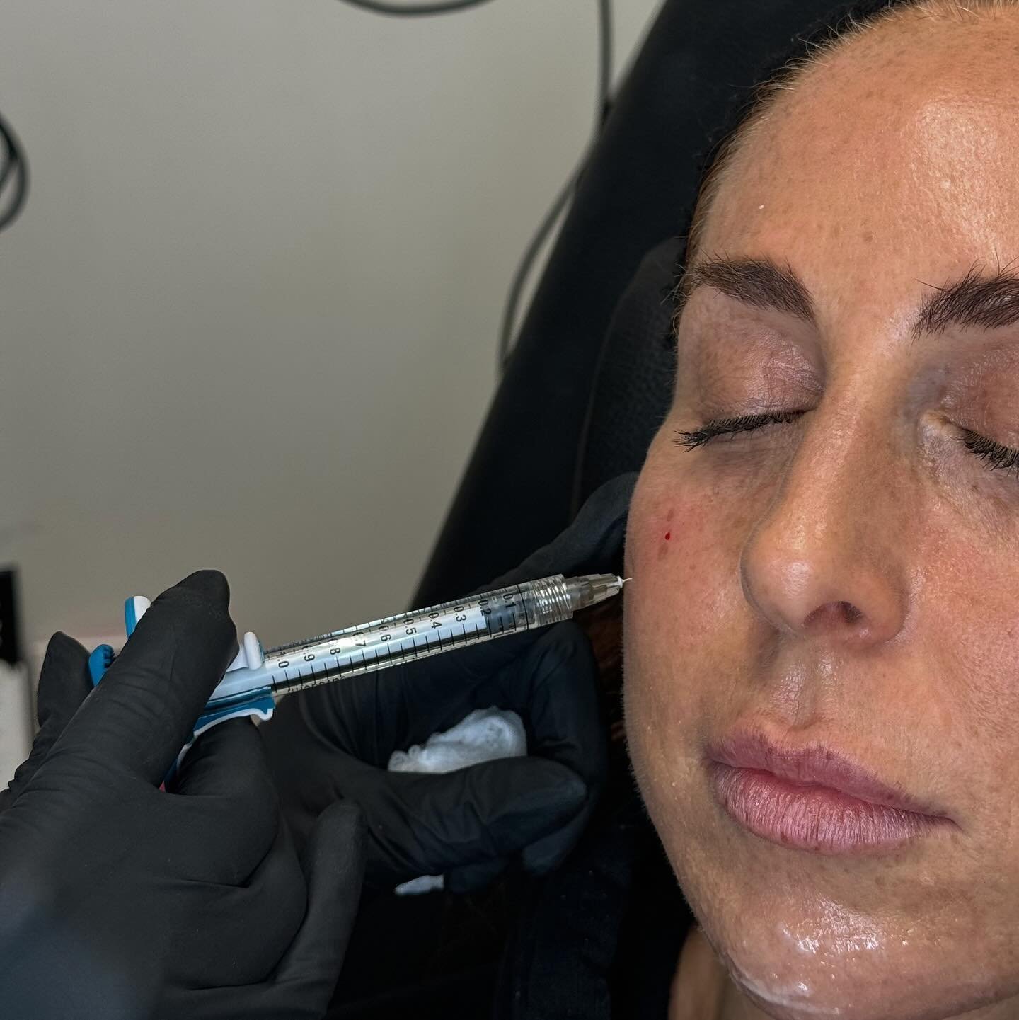 Cheek fillers are dermal fillers injected into the cheeks to restore lost volume, enhance facial contours, and achieve a more youthful appearance. There are different types of fillers, but most are made of hyaluronic acid (HA), a naturally occurring 