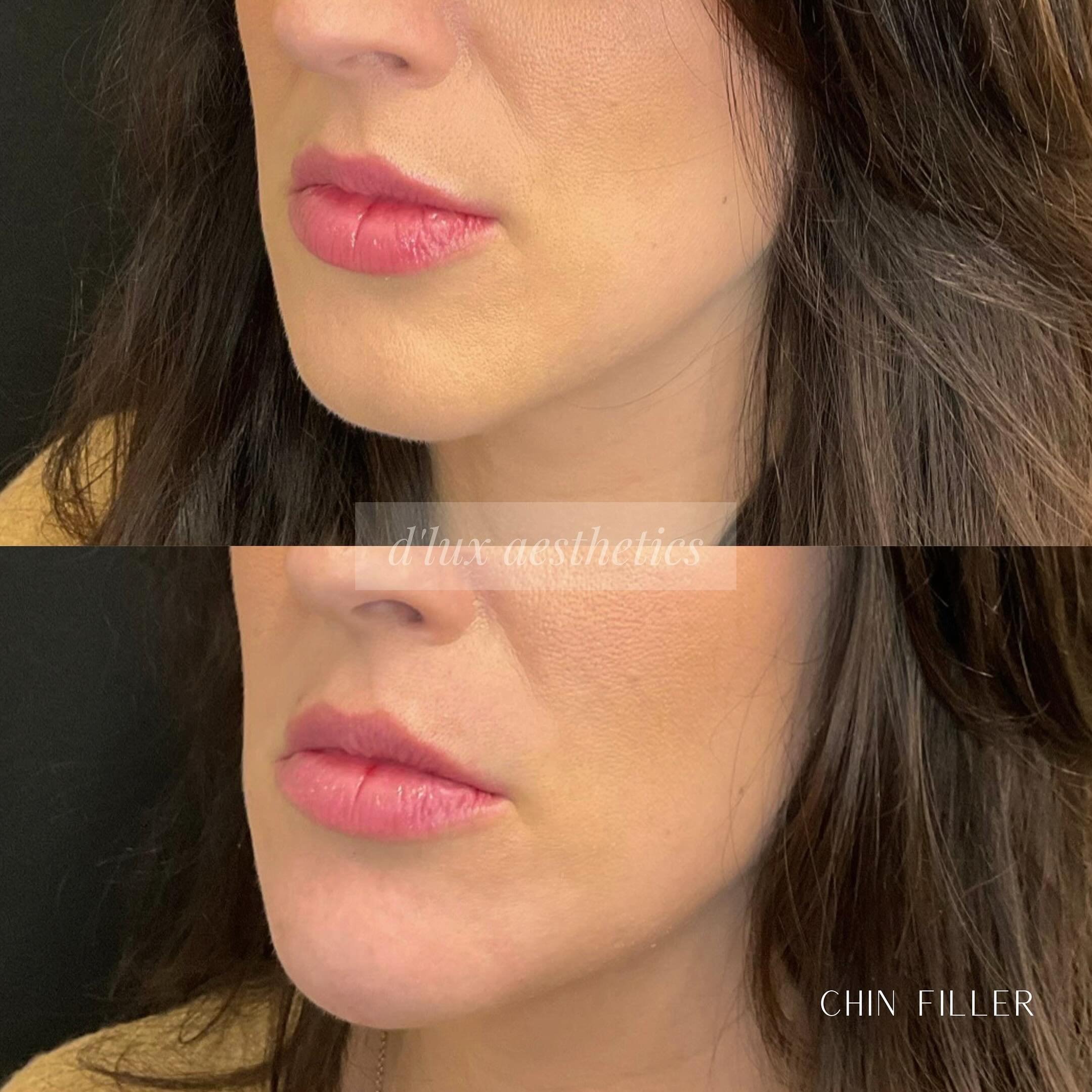 Projection is key 💉 | @juvederm 

For this patient we used JUV&Eacute;DERM VOLUX to achieve a projected, rounded out chin. ✨

-Intended for US Audiences only
-Results may vary
-For important safety information see @juvederm 
#juvedermcoopprogram 

?