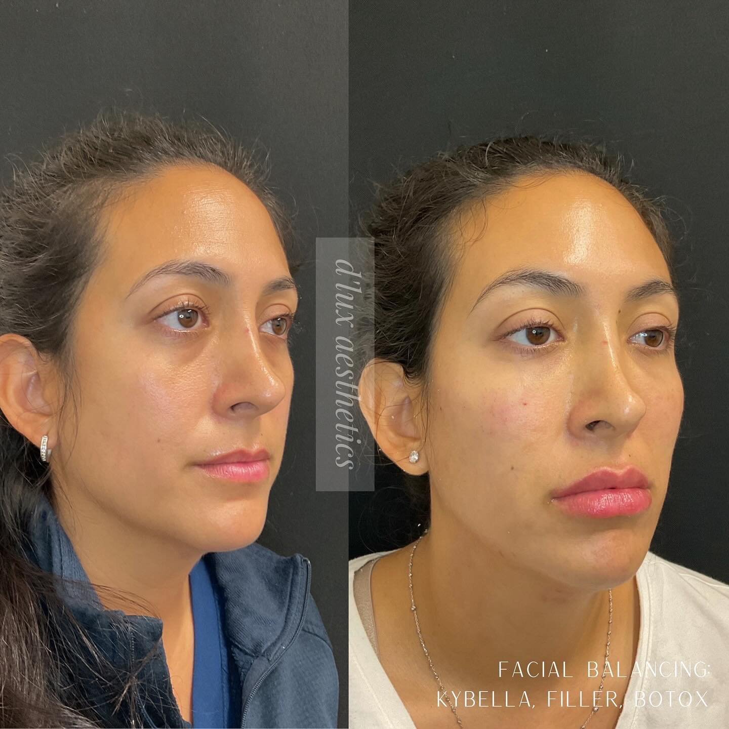 Aesthetics is a journey!  What did we treat on this beautiful patient? 

- 6 vials of Kybella to the submentum or &ldquo;double chin&rdquo;
- 4 syringes of Voluma to the cheeks 
- 1 syringe of Volbella to the tear troughs 
- 1st syringe to lips was V