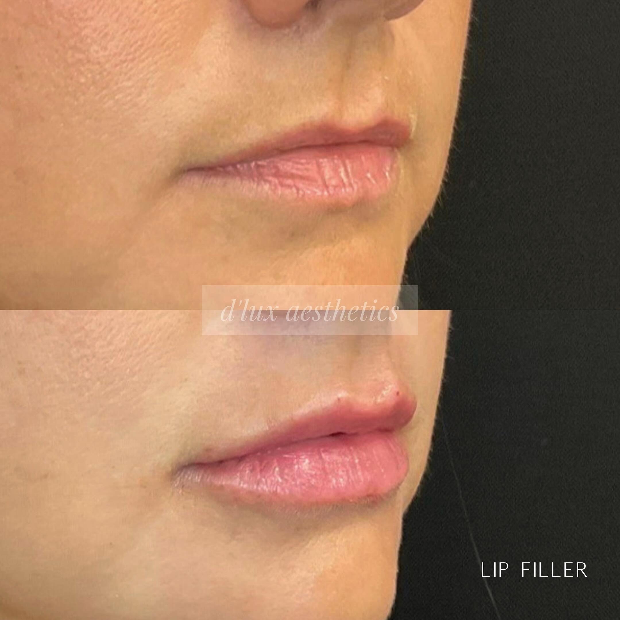 Starting small with this first time lip filler patient 💋✨

Building up lip filler gradually over multiple sessions offers several advantages over getting a large amount injected all at once. Here&rsquo;s why it&rsquo;s important:

More Natural Look: