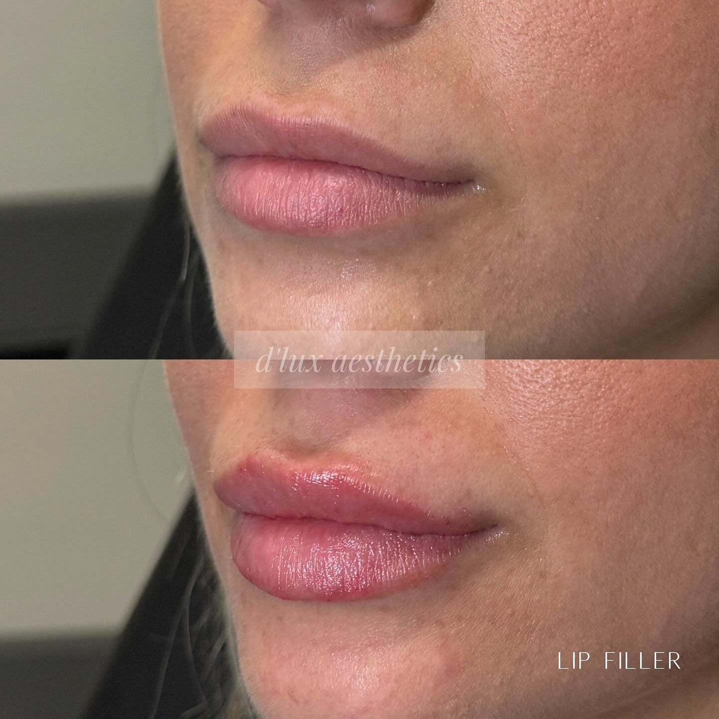 Say yes to a new pout 💋 | @juvederm 

For this patient we used .5ML of JUV&Eacute;DERM ULTRA PLUS to achieve a little extra plump and correction of asymmetry.

-Intended for US Audiences only
-Results may vary
-For important safety information see @