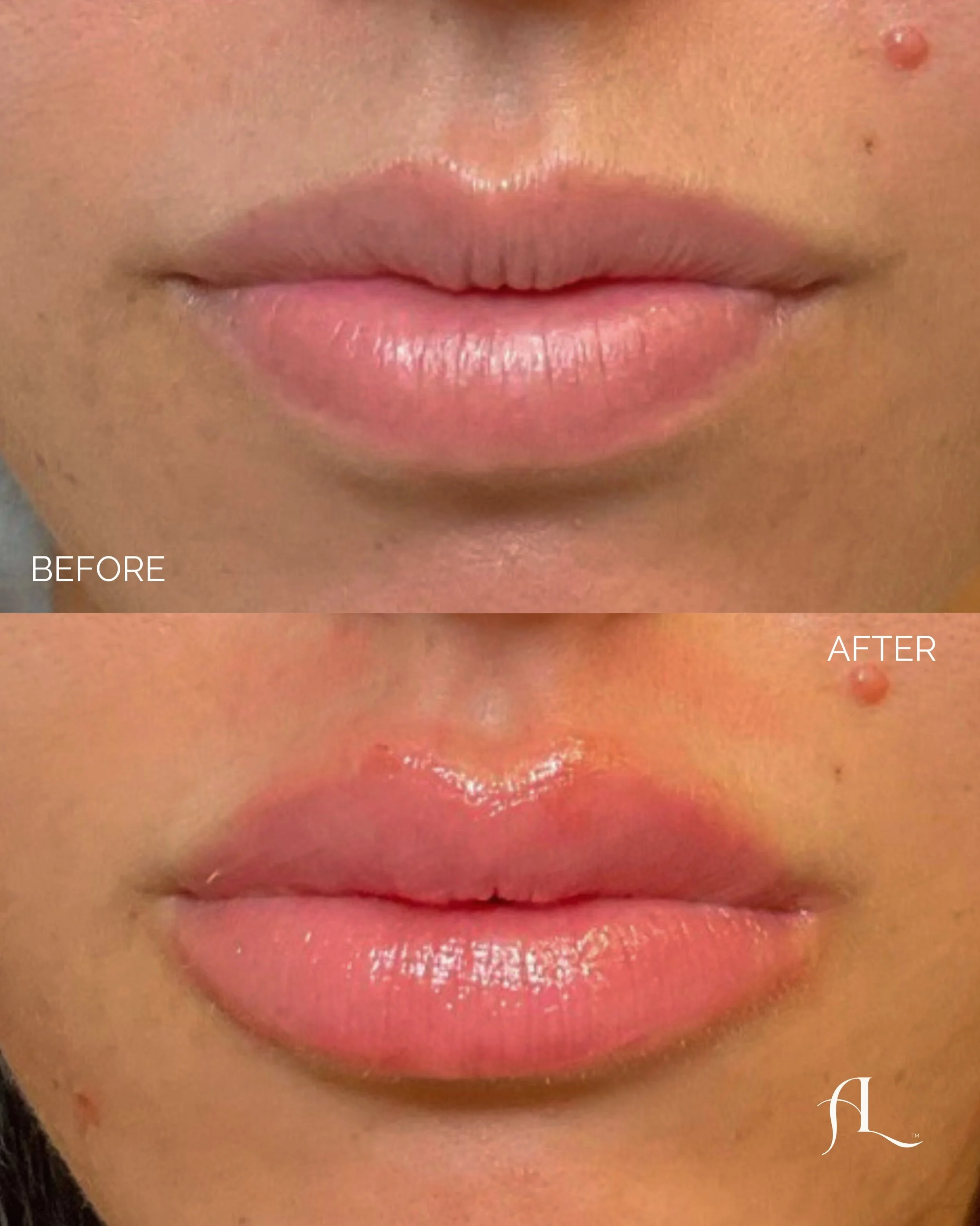 Not every lip needs more. Sometimes it needs a better strategy. 👄

Filler isn&rsquo;t just about adding volume. It&rsquo;s about understanding how your lips move, where they naturally lack definition, how they balance with the rest of your face, and