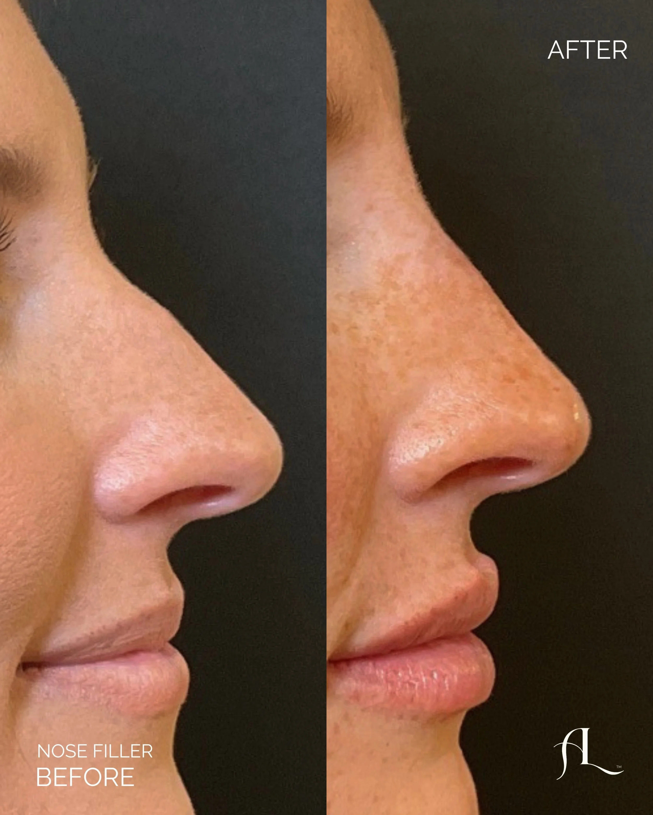 Look at what a little refinement can do ✨

It&rsquo;s amazing what happens when you stop looking at features individually and start looking at the face as a whole.

Her nose and lips played a major role in creating better balance within her profile. 