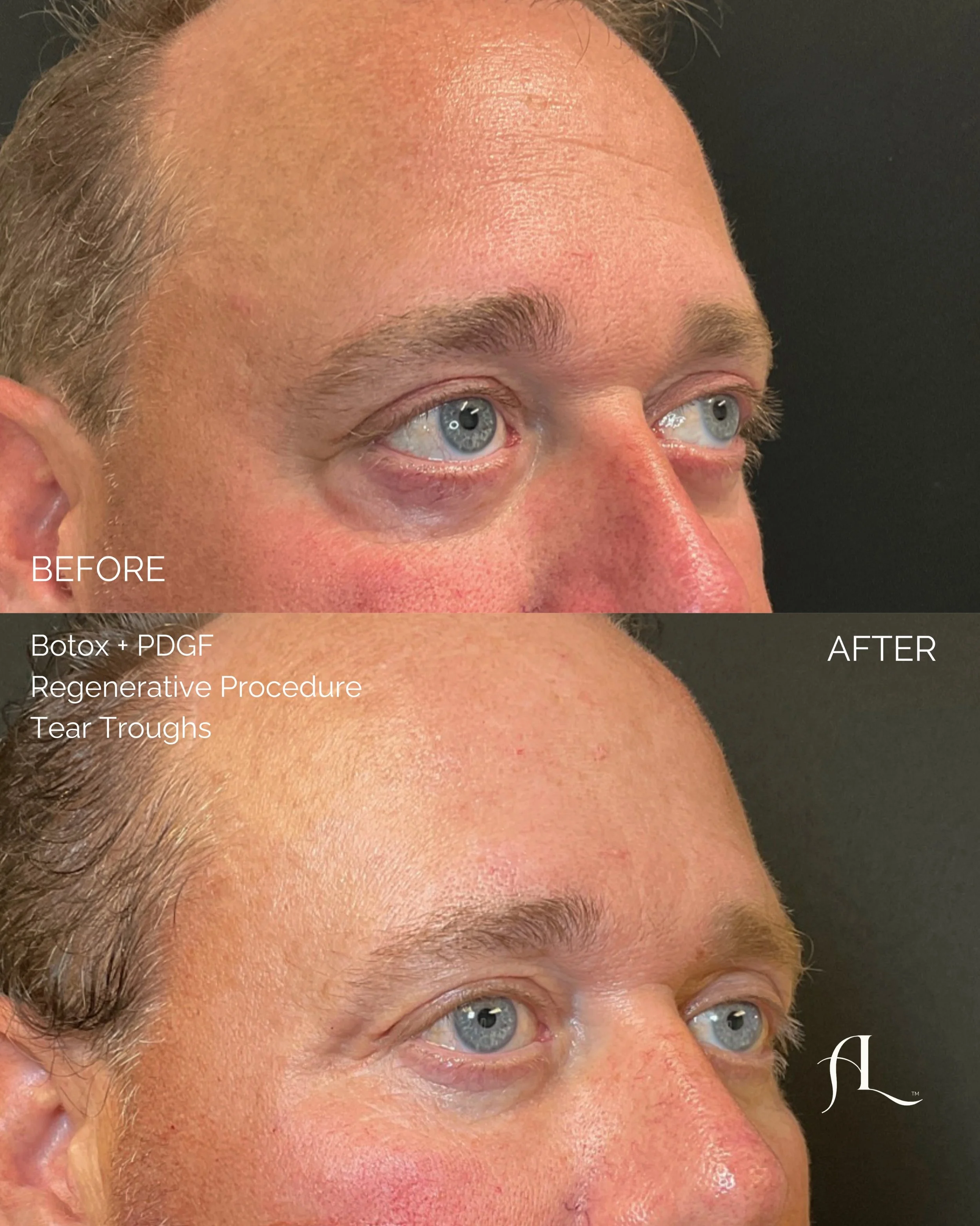 Two years of consistency can make a significant difference.

This before and after shows the result of a long term, full face approach rather than a one time treatment. 

His plan included:
-Full Face Botox
-1 HA filler treatment + three PDGF regener