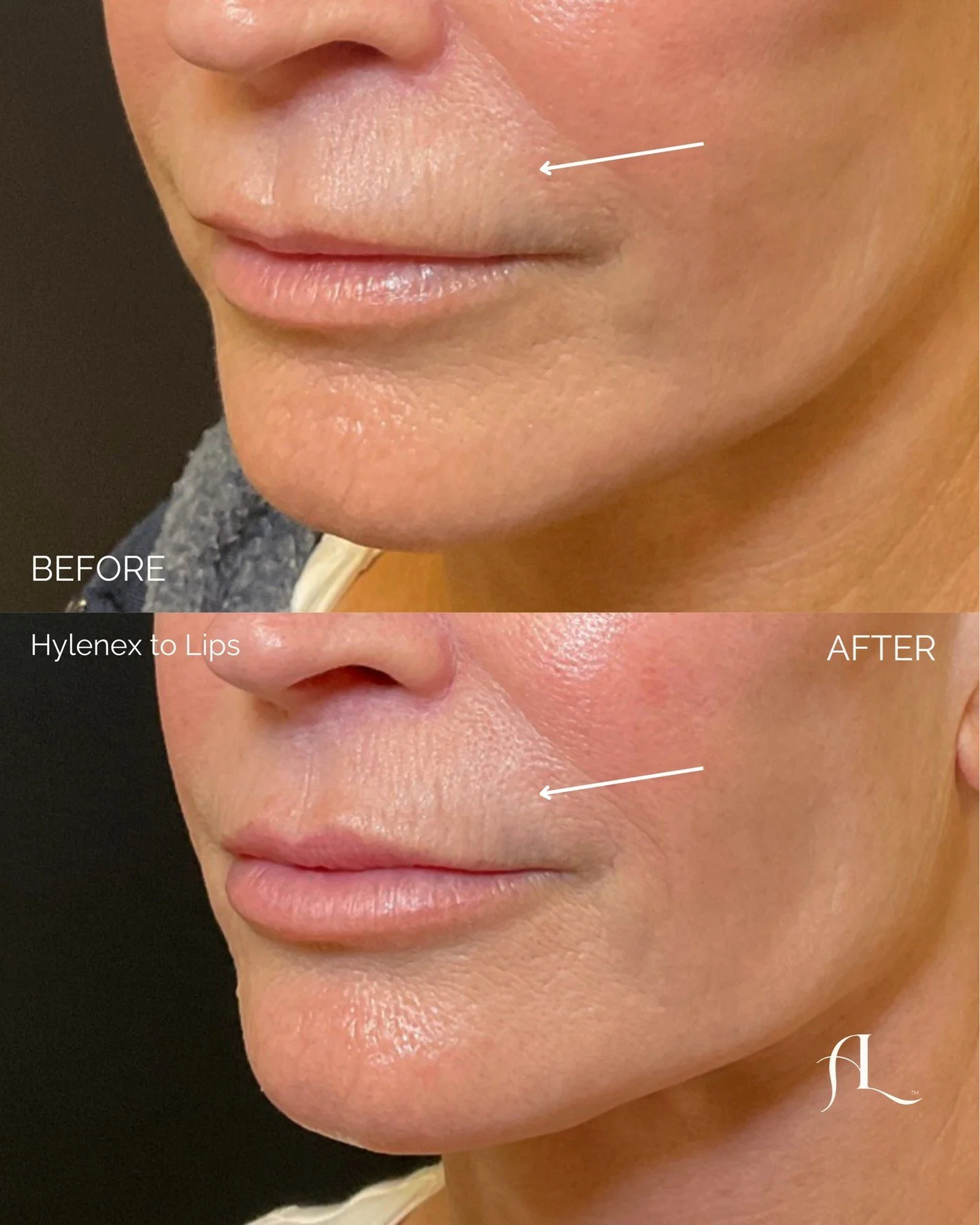 Sometimes the answer to a heavy, downward turned lip isn&rsquo;t more filler. It&rsquo;s removing what&rsquo;s already there.

Previous lip or perioral filler can become displaced, adding weight around the lip and contributing to decreased pink tissu