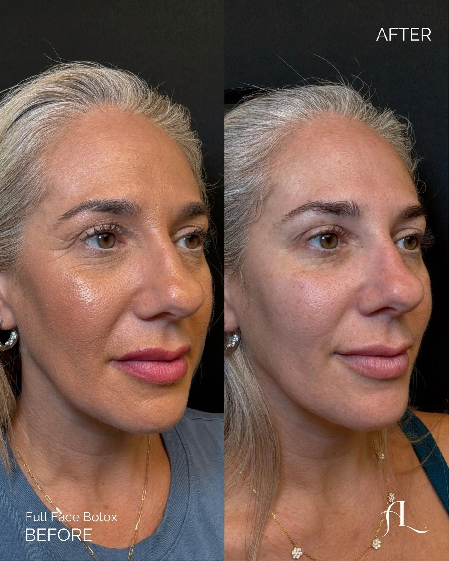 No Botox + makeup&hellip;
No makeup + Botox. ✨

Don&rsquo;t we all want to wake up like this?! 

This is a full face Botox approach designed to soften lines while maintaining natural movement and expression. Treatment areas included the frontalis, gl
