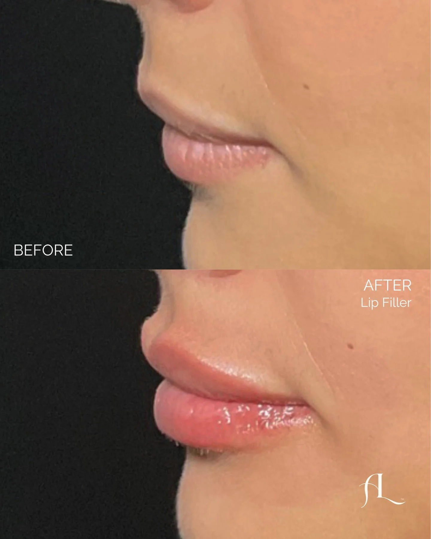 Your first time getting lip filler doesn&rsquo;t have to be scary!

This before and after shows how even a first treatment can enhance your natural lip shape, improve definition, and give the lips a more hydrated, refreshed appearance without going o