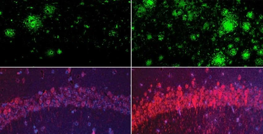 Alzheimer's Affects 50M to 400M Worldwide But a Recent Study Offers Hope