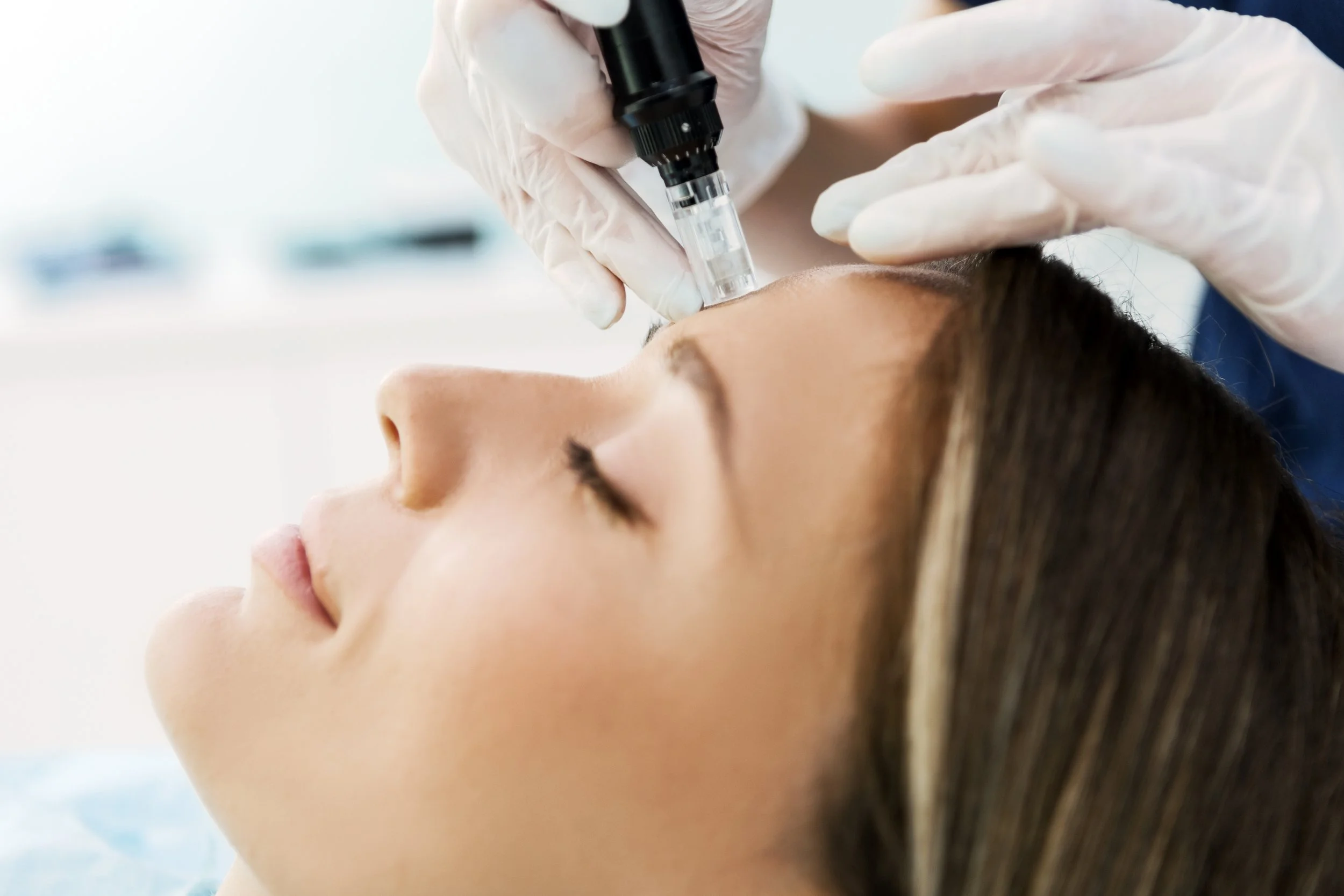 Collagen Induction Therapy