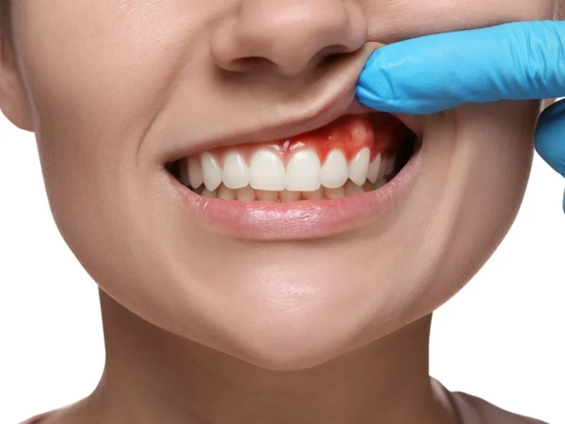 Oral Microbial species, Cognitive decline and Alzheimer's disease