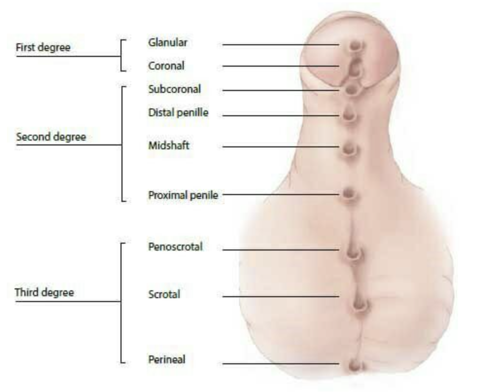 Hypospadias variations
