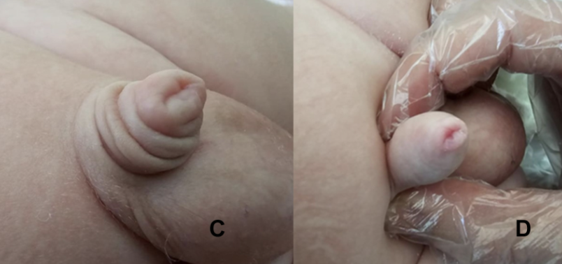 'Concealed' or 'Inconspicuous' Penis