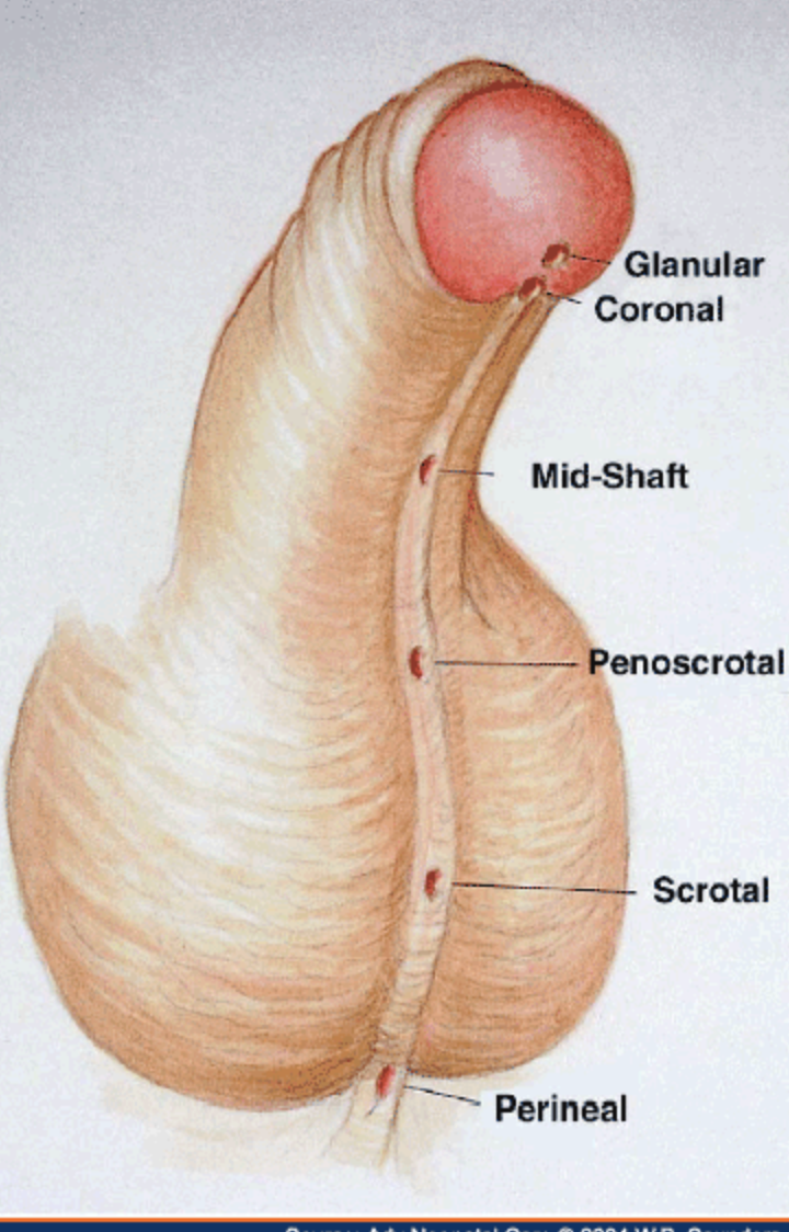 Hypospadias variants