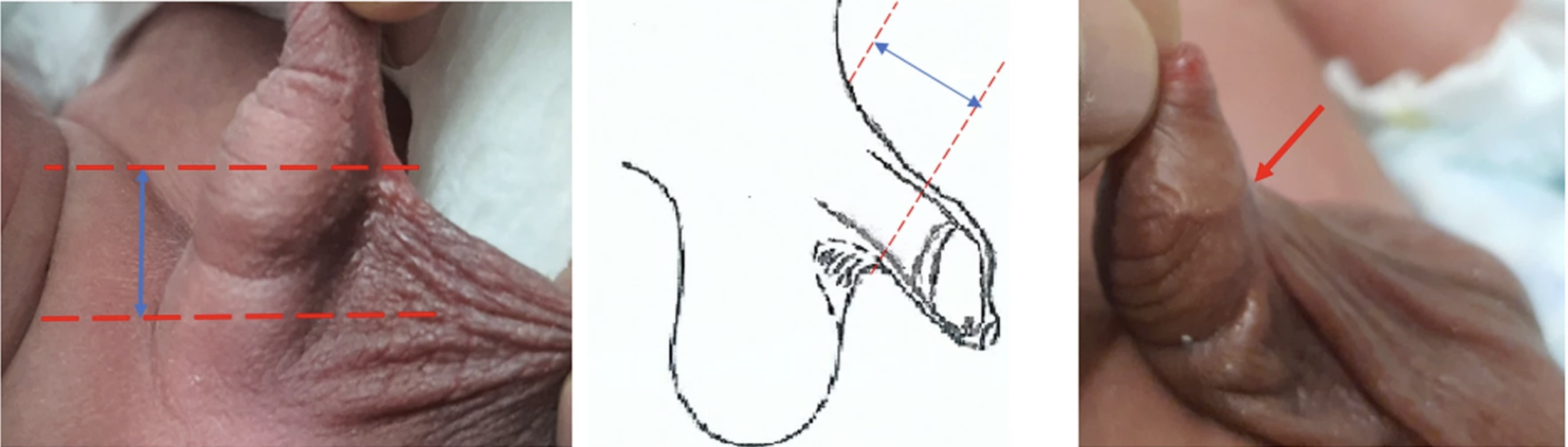 Webbed penis in a newborn