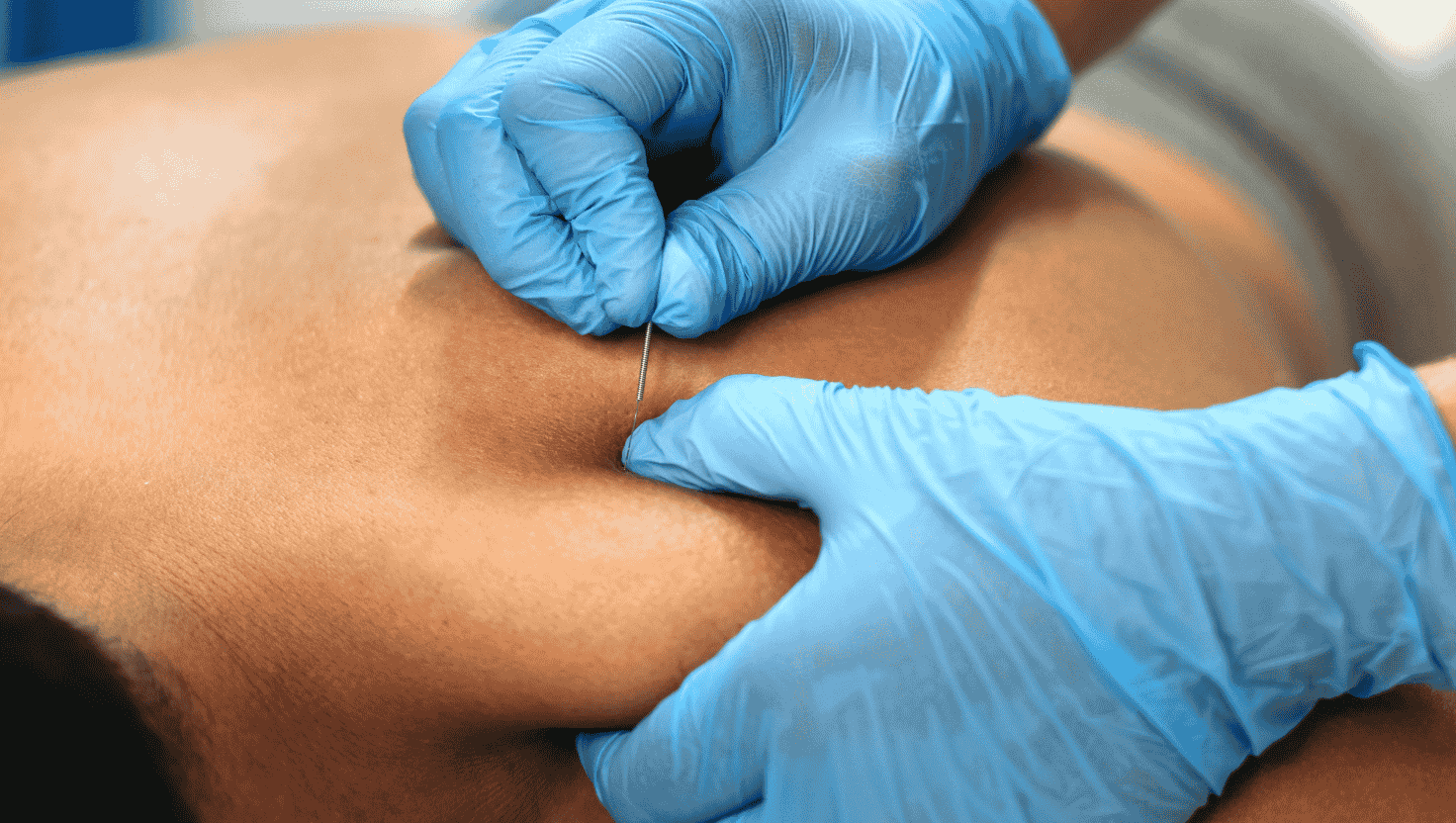Dry needling therapy might include mild discomfort, however this discomfort is usually minimal.